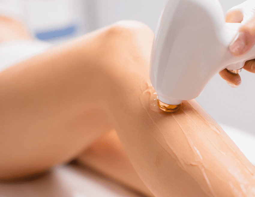 depilación médica con Candela ®