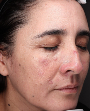 rosacea sintomas y tratamiento
