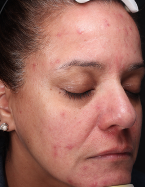 rosacea sintomas y tratamiento